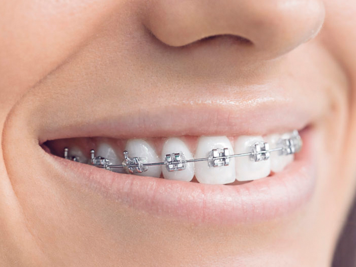 Braces & Aligners