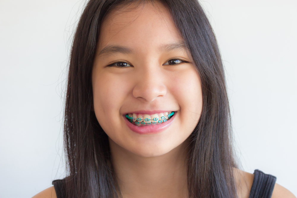 what-you-should-know-about-kids-braces
