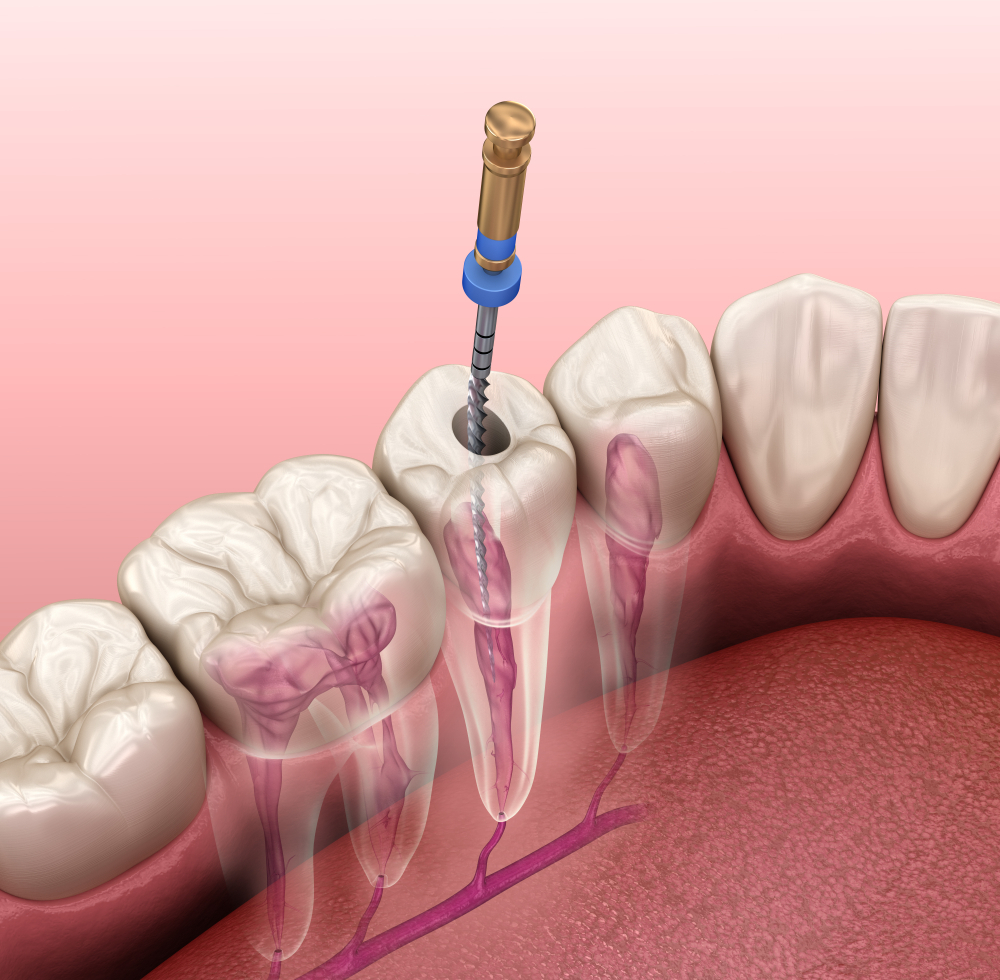 Do You Really Need Root Canal Treatment?
