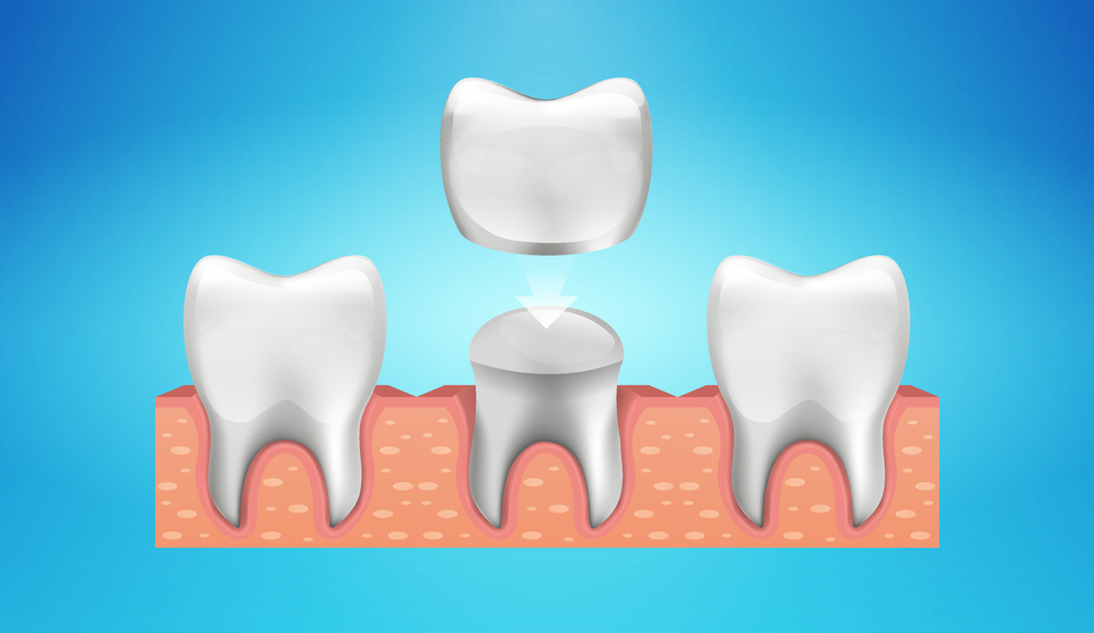 soft-teeth-and-some-hard-facts-to-learn-about-them