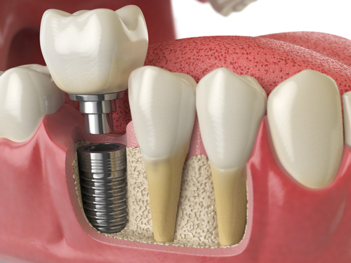 is-dental-implant-a-permanent-treatment-for-you