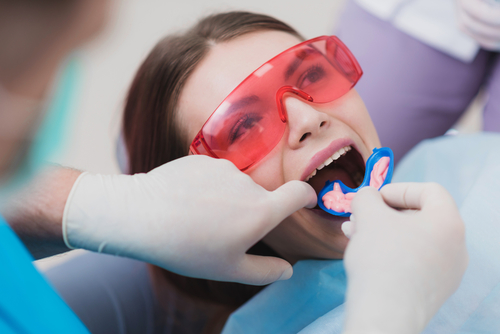 fluoride-and-facts-you-need-to-know-in-devshree-dental-care