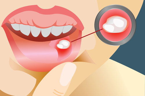 canker-sores-how-to-treat-them