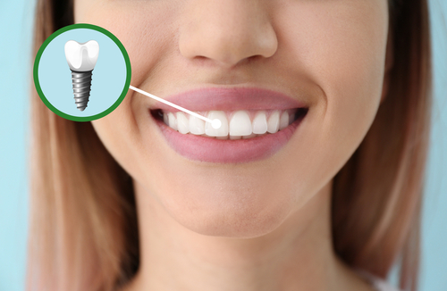 what-are-the-main-parts-of-a-dental-implant