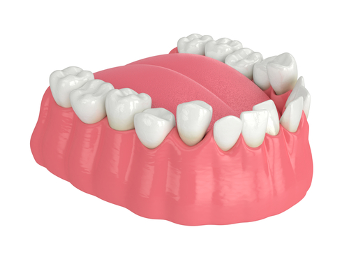 what-is-misalignment-of-teeth-how-to-correct-it