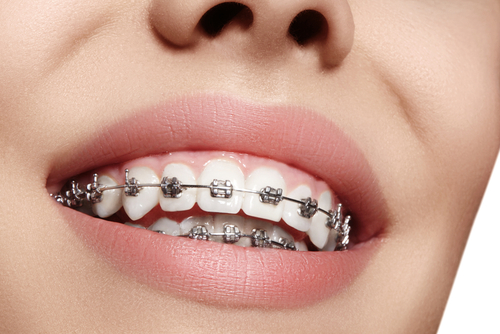 braces-101-heres-your-quick-guide-to-braces